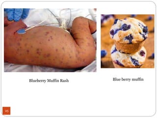 Torch Infection Rashes TORCH Infection in neonate (newborn) | PPTX