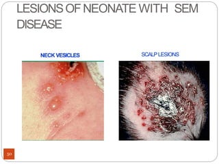 Torch Infection Rashes TORCH Infection in neonate (newborn) | PPTX