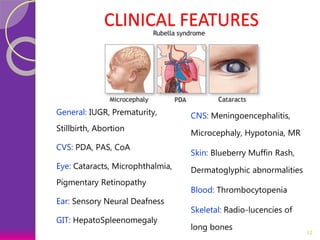 CLINICAL FEATURES
General: IUGR, Prematurity,
Stillbirth, Abortion
CVS: PDA, PAS, CoA
Eye: Cataracts, Microphthalmia,
Pigmentary Retinopathy
Ear: Sensory Neural Deafness
GIT: HepatoSpleenomegaly
CNS: Meningoencephalitis,
Microcephaly, Hypotonia, MR
Skin: Blueberry Muffin Rash,
Dermatoglyphic abnormalities
Blood: Thrombocytopenia
Skeletal: Radio-lucencies of
long bones
12
 