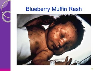 Blueberry Muffin Rash
13
 