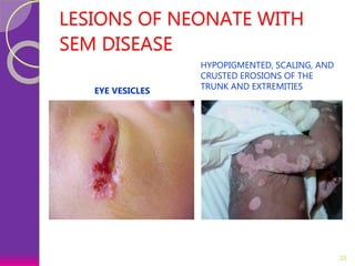 LESIONS OF NEONATE WITH
SEM DISEASE
25
EYE VESICLES
HYPOPIGMENTED, SCALING, AND
CRUSTED EROSIONS OF THE
TRUNK AND EXTREMITIES
 