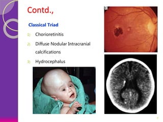 Contd.,
Classical Triad
1) Chorioretinitis
2) Diffuse Nodular Intracranial
calcifications
3) Hydrocephalus
7
 