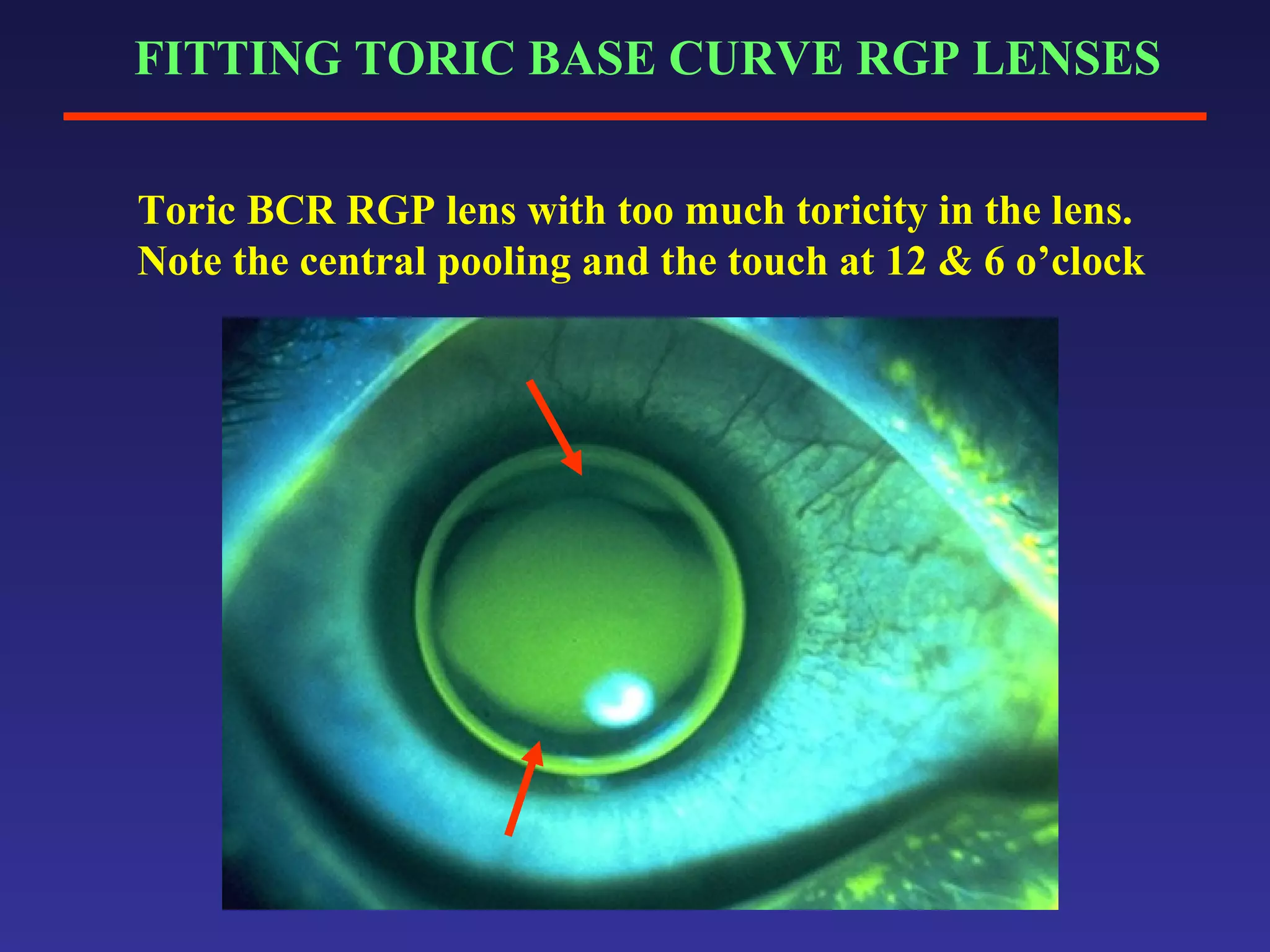 Trucone Rgp Toric rgp fit | PPT