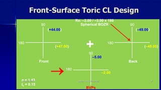 Front-Surface Toric CL Design
180
Rx: –2.00 / –3.00 x 180
Spherical BOZR90
Front
(+47.00)
(+44.00)
90
Back
180
(–49.00)
(–49.00)
90
BVPs
180
–2.00
–5.00

n = 1.43
tc = 0.15
+
14 July 2020 Optom. Ankit Varshney 24
 
