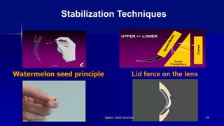 Watermelon seed principle
Stabilization Techniques
Lid force on the lens
14 July 2020 Optom. Ankit Varshney 29
 
