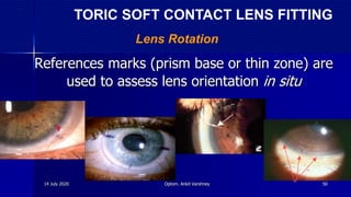 References marks (prism base or thin zone) are
used to assess lens orientation in situ
Lens Rotation
TORIC SOFT CONTACT LENS FITTING
14 July 2020 Optom. Ankit Varshney 50
 