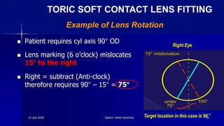  Patient requires cyl axis 90° OD
 Lens marking (6 o’clock) mislocates
15° to the right
 Right = subtract (Anti-clock)
therefore requires 90° – 15° = 75°
order
75°
105°
15° mislocation
Example of Lens Rotation
Target location in this case is 90°
Right Eye
TORIC SOFT CONTACT LENS FITTING
14 July 2020 Optom. Ankit Varshney 55
 