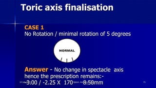 Toric axis finalisation
CASE 1
No Rotation / minimal rotation of 5 degrees
Answer - No change in spectacle axis
hence the prescription remains:-
-3.00 / -2.25 X 170 8.50mm 7114 July 2020 Optom. Ankit Varshney
 