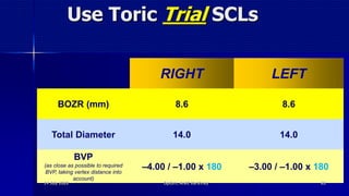 Use Toric Trial SCLs
RIGHT LEFT
BOZR (mm) 8.6 8.6
Total Diameter 14.0 14.0
BVP
(as close as possible to required
BVP, taking vertex distance into
account)
–4.00 / –1.00 x 180 –3.00 / –1.00 x 180
14 July 2020 Optom. Ankit Varshney 85
 