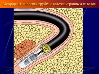 Микрорентгеновская трубка с автоэлектронным катодомМикрорентгеновская трубка с автоэлектронным катодом
 