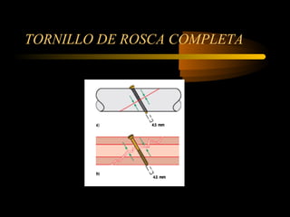 TORNILLO DE ROSCA COMPLETA 
 