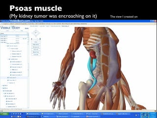 "Gimme my damn data!" - e-Patient Dave's keynote at Medicine 2.0 2009