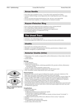 OP20 OphthalmoloBf
16. Canj11nctinl Hypar•i•
vs. CiliaryRush
CorneaflheUTeal.Tract 1'oroDio 2011
Arcus Sanilis
• hazywhite ringinperipheralcornea, <2 mmwide, clearlyseparatedfrom limbus
• common,bilateral, benign corneal degeneration dueto lipiddeposition, partofthe aging
process
• maybe associatedwithhypercholesterolemiaifage <40yean, check.lipidprofile
• no assoclatedvisualsymptoms, no complications, no treatmentnecessary
Kayser-Fleischer Ring
• brown-yellow-green plgmented ringin peripheralcornea, startingInferiorly
• dueto deposition ofcopperpigmentin Descemet's membrane
• associatedwithWilson'sdisease (9596, b.epatolenticula.rdegeneration)
• no associs.tedsymptoms or complications ofring
• treat underlyingdisease
The Uveal Tract
• uvealtract= iris,ciliarybody. choroid
• vascularized, pigmentedmiddle layer ofthe eye, between the scleraandtheretina
Uveitis
• mayinvolveone orallthree parts ofthetract
• idlopathicor associatedwithautolmmune, infectious,granulomatcus, malignant causes
• shouldbe managedbyanophthalmologist
Anterior Uveitis (Iritis)
• ln1lammation ofIris, usuallyaccompaniedbycyclitis (Inflammation ofciliarybody), whenboth
= iridocyclitis
• usuallyunilateral
Etiology
• usuallyidiopathic
• connectivetissue diseases
• HLA-B27: reactive arthritis, ankylosing spondylitis (AS), psoriatic arthritis, inflammatory
boweldisease (IBD)
• non-HLA-B27: juvenileidiopathicarthrit:is (JIA)
• infectious: syphilis, Lymedisease, toxoplasmosis, TB, HSY, herpes zoster
• other: sa.rooidosis,trauma, large abrasion,postocularsurgery
Clinieel fHtures
• photophobia(dueto reactivespasm ofinflamedirismuscle), ocularpain, tenderness ofthe
globe,browache (ciliarymuscle spasm), decreasedvisualacuity,tearing
• ciliaryflush (perilimbel conjunctivalinjection), miosis (spasm ofsphinctermuscle) (Figure 16)
• anteriorchamber"cells"' (WBCin anteriorchamberdueto anteriorsegmentinflammation)
and"ffare'" (protein predpltatesin anteriorchambersecondaryto in11ammation),hypopyon
(collectionofneutrophilicexudatesinferiorlyin the anteriorchamber)
• occaslonallykeratl.cprecipitates (clumps ofcells on corneal endothelium)
• iritistyplcallyreduces intraocularpressurebecause dllarybodyinflammationcausesdecreased
aqueousproduction;however. severeIritis, oriritisfrom herpes simplexandzostermaycause
aninflammatoryglaucoma
Compliartions
• infl.amma.toryglaucoma
• posteriorsynechiae
• adhesions ofporterioriristo anteriorlens capsule
• indicated byan irregularlyshapedpupil
• ifoccurs 360m, entrapsaqueousinporteriorchamber, irisbomforward "irisbomb€
' -+
angleclosureglaucoma
• peripheralanteriorsynechiae (PAS) (rare): adhesionsofiristo cornea-+ glaucoma
• cataracts
• bandke:ratopathy(withchronic iritis)
• superficialcornealcalcificationkeratopathy
• macularedemawith chroniciritis
 