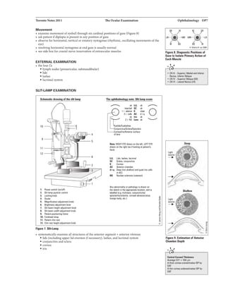 'IbroDloNota2011
Movement
• examine movement ofeyeball throughsix cardinal positionsofgaze (Figure8)
• askpatientifdiplopiais presentinanypositionofgaze
• ohllerve for horizontal, vertical or rotatorynystagmus (rhythmic, oscillatingmovements ofthe
eye)
• resolvinghorizontal nystagmus at endgazeis usuallynormal
• see sideboxfor cranialnerve Innervationofextraocularmuscles
EXTERNAL EXAMINATION
• thcfuurTh
• lymph nodes (preauricular, submandibular)
• ll.d8
•lashes
• lacrimal system
SUT·LAMP EXAMINATION
1. l'owllrlliWib;h !orVDff)
2. Slit limpjoyltic:k canlnll
3. l..oeki1gknob
ol. Ocular
5. Mllgnilicatian kmb
I. Brightnass lll;.stmantllw«
1. Slit beam hllittrt11$1&1mantknob
I. Slit beamwidlh lldjJstmentknob
9. Palient-P"ilirilutiwne
1D. Fanll,.j lltAp
11. l'aliantchiueat
12. Cl*l reathe9rt knob
Figura 7. Slit-L..mp
Tha aph'llllholagy nolll: Sitlimp 111111m
,....-....., '* LU ok
injectad SC ok
1+ .... I( cle.-
2+ calli AC d+q
:::..::
Dllllailris/Antaiorawfm:e
oflans
0
lale: RIGHTEYE dnrwn onlhe left, LEfT EYE
cnwnonlha right(88 i looking atpatient'•
face).
Ill L.ids,luha, lacrimal
SC: Sclera. conjllllltiva
I Cornea
AC Anteriorchamller
d+• Daap (notshllowland quia! lno eels
inAC)
IS
Allyabnormalityorpathology is4hwn on
1118sketch II1118approprilllllocation, and is
labellllla.g.1richilail.oon.iunetivitisl
apisclaritiii'ICIIritia. canwalllllruia111ulcar,
foraign body, etc.)
• systematicallyaamine allstructuresoftheanteriorsegment+anteriorvitreous
• lids (includingupper lidewrsion ifnecessary), lashes, andlacrimalsystem
• conjunctiva andsclera
• cornea
• iris
OphthalmolOBY 01'7
SR 10
LR
'
.,
, /Sit
Milo Ji5 •LR
IR SO
C ShorryH. Lli 200&
Figura I. Dill•oatic Pasil:ia• Df
GilD1D llallltB Prim1ry Ac:tia• of
EaGIJMacle
...... ',
.
• CN Ill - Suplliot Madill IIIII lnillriar
11actus. lnflliorOlllique
• CN IV- Superior ISO)
• CNVI - l.attnll Rectu•!LR)
---
Sbalow
Light
10Un:8
---+
9. Ellimetian ofAllteriar
Cha•b• hptll
..... ,
Cellini Comaln--...
A¥11111111CCT = 550 IIIII
Alhi:k CDRIIIIIJIIIIrllllirnlllaiiDP by
GAT
Athin com811Dda11181irnlllaiiOP by
GAT
 