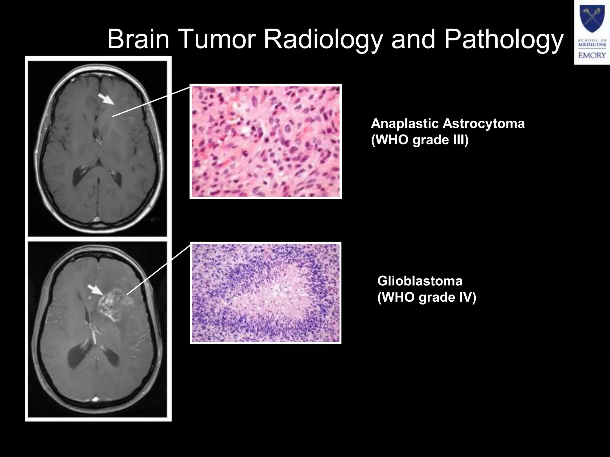 Brain Tumor Radiology and Pathology

                    Anaplastic Astrocytoma
                    (WHO grade III)




                    Glioblastoma
                    (WHO grade IV)
 