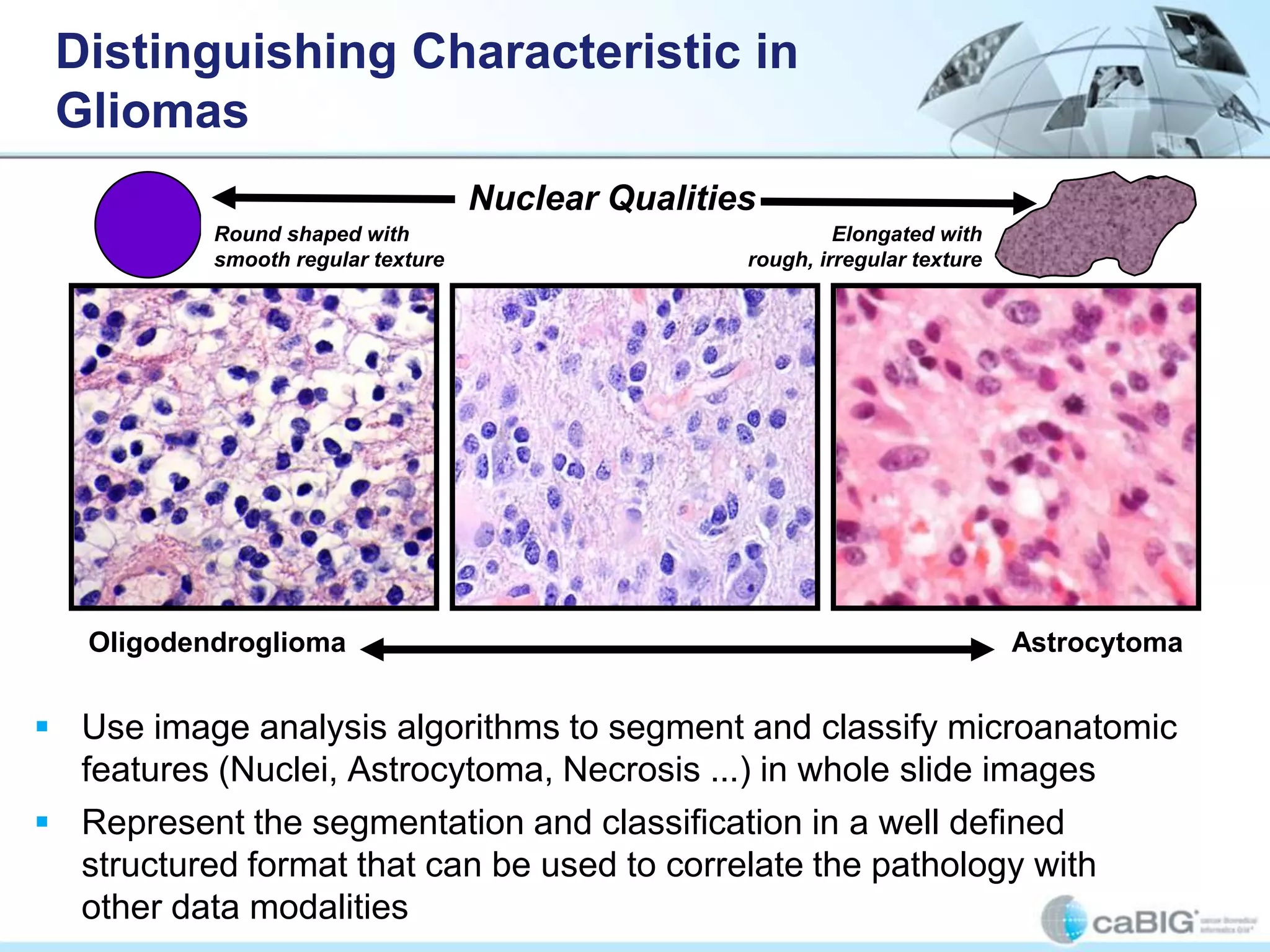 Distinguishing Characteristic in
 Gliomas
                                    Nuclear Qualities
           Round shaped with                                 Elongated with
           smooth regular texture                   rough, irregular texture




   Oligodendroglioma                                                           Astrocytoma


 Use image analysis algorithms to segment and classify microanatomic
  features (Nuclei, Astrocytoma, Necrosis ...) in whole slide images
 Represent the segmentation and classification in a well defined
  structured format that can be used to correlate the pathology with
  other data modalities
 