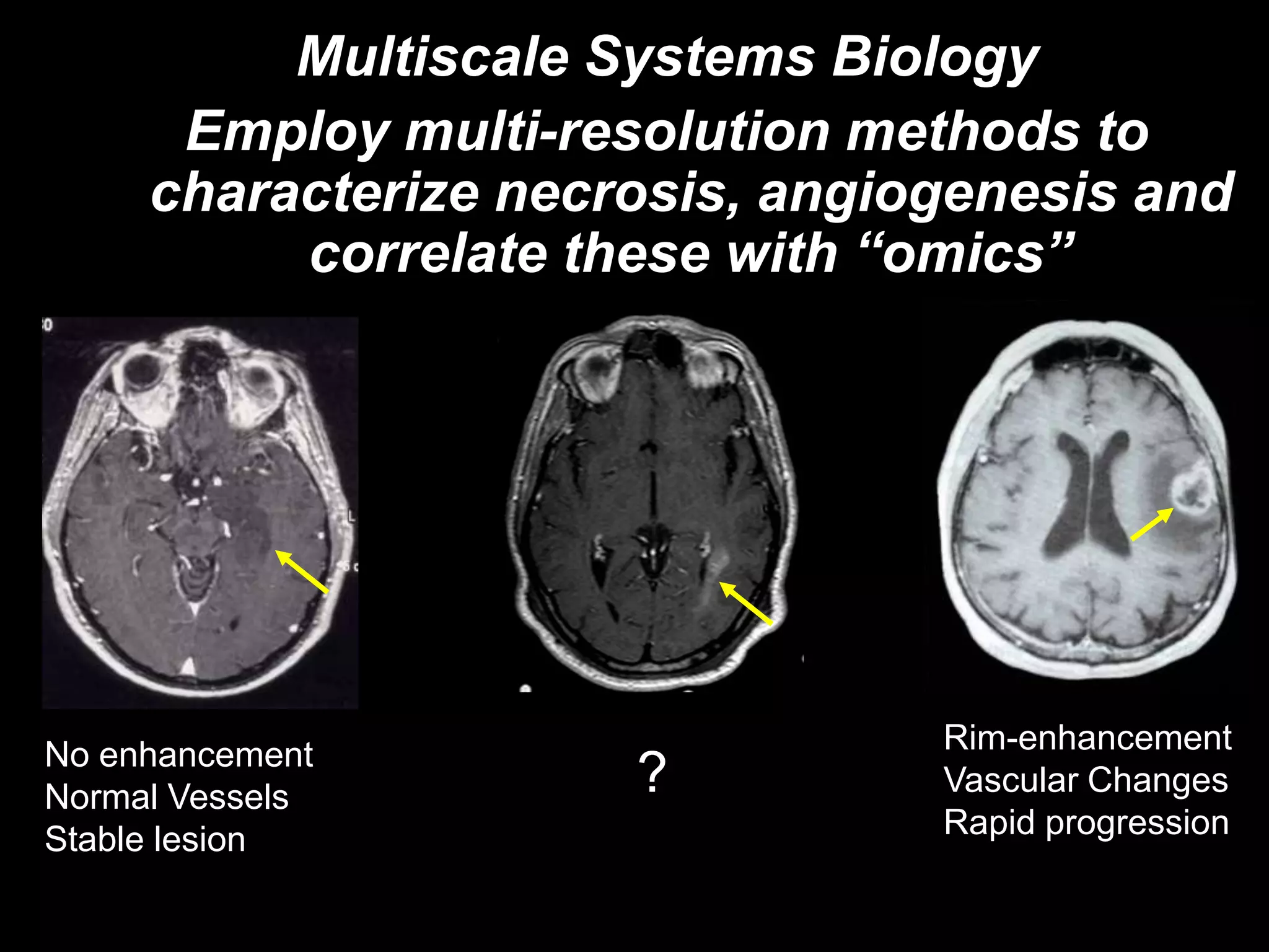 Multiscale Systems Biology
      Employ multi-resolution methods to
     characterize necrosis, angiogenesis and
          correlate these with “omics”




No enhancement                   Rim-enhancement
Normal Vessels        ?          Vascular Changes
Stable lesion                    Rapid progression
 