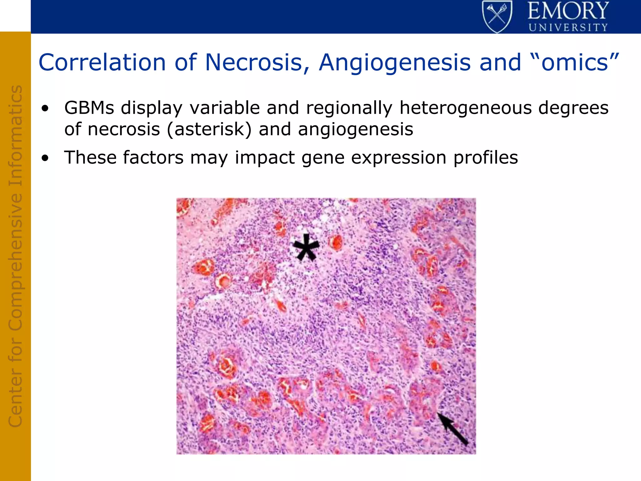 Correlation of Necrosis, Angiogenesis and “omics”
Center for Comprehensive Informatics




                                       • GBMs display variable and regionally heterogeneous degrees
                                         of necrosis (asterisk) and angiogenesis
                                       • These factors may impact gene expression profiles
 