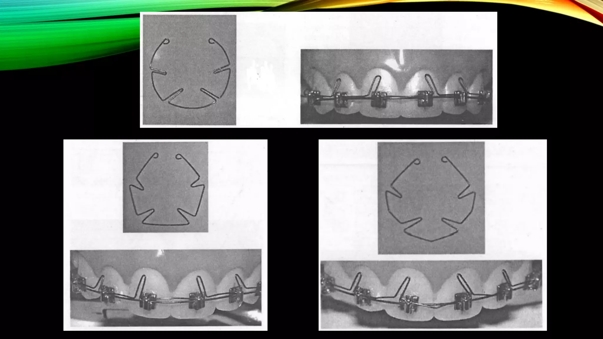 Root Torque Tooth The Root Torqueing Auxiliaries in Orthodontics | PDF