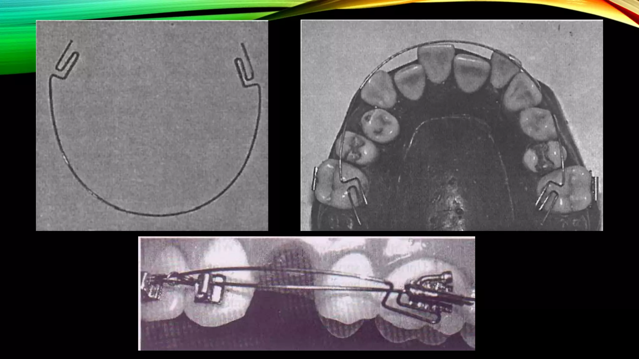 Root Torque Tooth The Root Torqueing Auxiliaries in Orthodontics | PDF