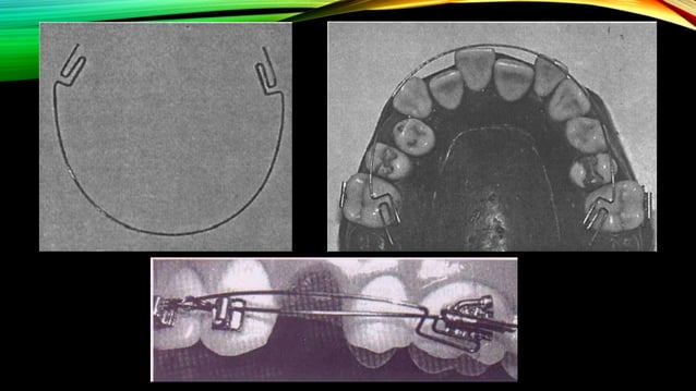 The Root Torqueing Auxiliaries in Orthodontics | PDF | Oral care ...