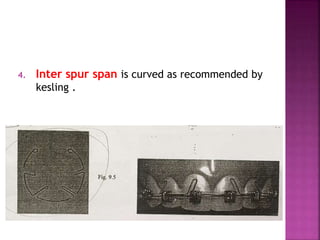 4. Inter spur span is curved as recommended by
kesling .
 