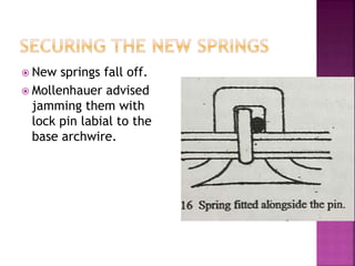  New springs fall off.
 Mollenhauer advised
jamming them with
lock pin labial to the
base archwire.
 