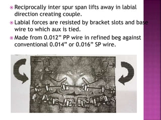  Reciprocally inter spur span lifts away in labial
direction creating couple.
 Labial forces are resisted by bracket slots and base
wire to which aux is tied.
 Made from 0.012” PP wire in refined beg against
conventional 0.014” or 0.016” SP wire.
 
