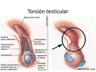Torsión testicular
 