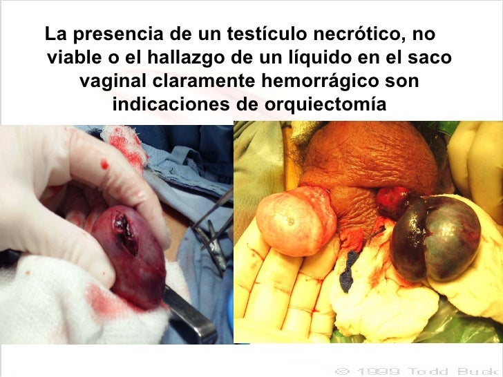 Se Puede Hacer El Laser En Los Testiculos Torsion Testicular