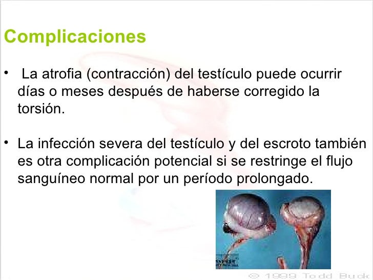 Torsion Testicular
