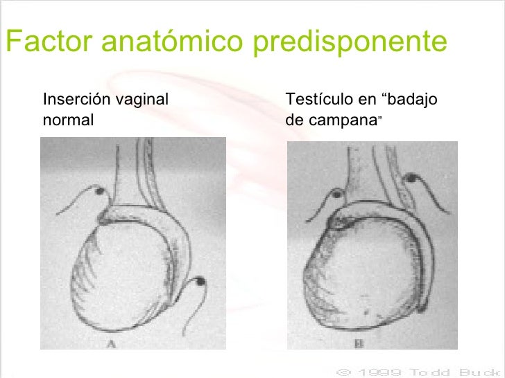 Torsion Testicular