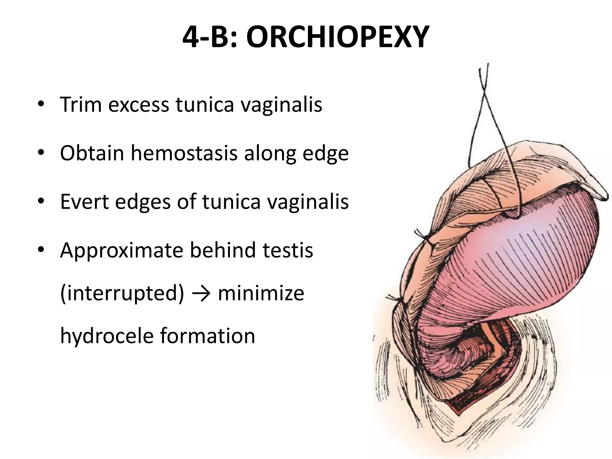 Torsion testis - Operative chat | PPTX
