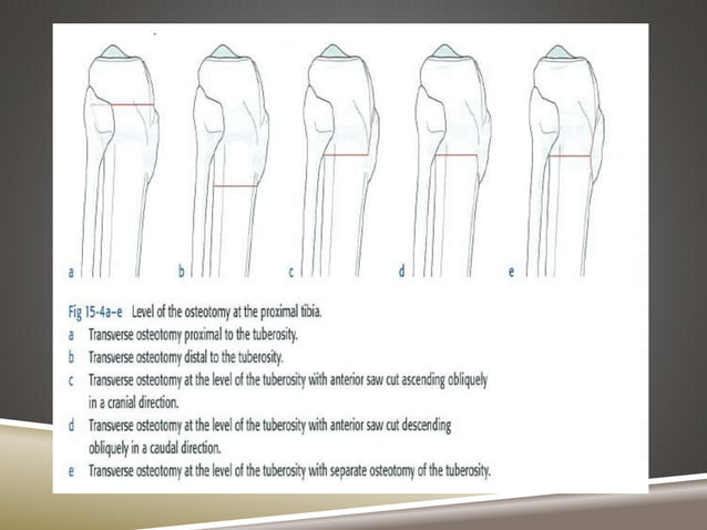 Torsion tibial | PPTX