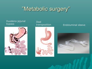 ””Metabolic surgery”Metabolic surgery”
Duodeno-jejunal
bypass
Ileal
transposition Endoluminal sleeve
 