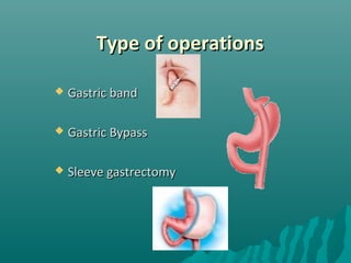 Type of operationsType of operations
 Gastric bandGastric band
 Gastric BypassGastric Bypass
 Sleeve gastrectomySleeve gastrectomy
 