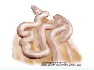 Laparoscopic gastric bypass
Olbers, Lönroth et al, Obesity Surgery 2003
 
