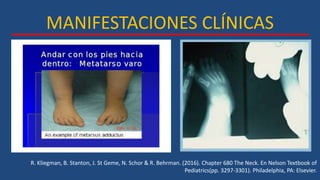 MANIFESTACIONES CLÍNICAS
R. Kliegman, B. Stanton, J. St Geme, N. Schor & R. Behrman. (2016). Chapter 680 The Neck. En Nelson Textbook of
Pediatrics(pp. 3297-3301). Philadelphia, PA: Elsevier.
 