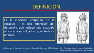 DEFINICIÓN.
Es la elevación congénita de la
escápula, es una alteración del
desarrollo que incluye una escápula
alta y una movilidad escapulotorácica
limitada.
R. Kliegman, B. Stanton, J. St Geme, N. Schor & R. Behrman. (2016). Chapter 681 . The Upper Limb. En Nelson Textbook of
Pediatrics(p.3302). Philadelphia, PA: Elsevier.
 