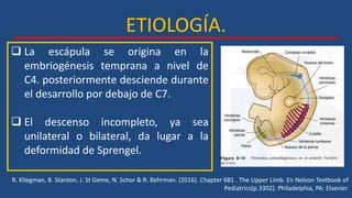 ETIOLOGÍA.
 La escápula se origina en la
embriogénesis temprana a nivel de
C4. posteriormente desciende durante
el desarrollo por debajo de C7.
 El descenso incompleto, ya sea
unilateral o bilateral, da lugar a la
deformidad de Sprengel.
R. Kliegman, B. Stanton, J. St Geme, N. Schor & R. Behrman. (2016). Chapter 681 . The Upper Limb. En Nelson Textbook of
Pediatrics(p.3302). Philadelphia, PA: Elsevier.
 