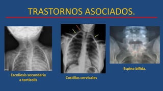 TRASTORNOS ASOCIADOS.
Escoliosis secundaria
a torticolis
Costillas cervicales
Espina bífida.
 