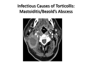 Infectious Causes of Torticollis:
Mastoiditis/Bezold’s Abscess
 
