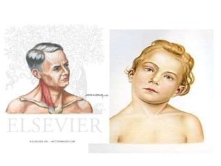 Introduction
• Torticollis refers to a symptom rather than a
distinct disease process
• It can be caused by a wide variety...