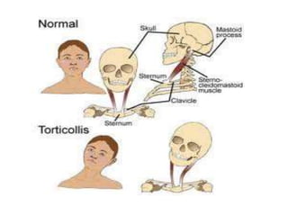 Congenital muscular torticollis
• Presentation is usually during the first 4
weeks of life with torticollis and / or
nonte...