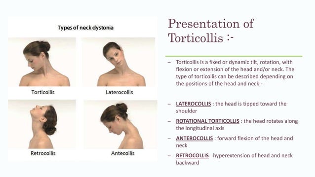 Torticollis And Its P T Management PPTX Torticollis And Its P T Management 4 638 