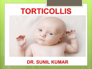 TORTICOLLIS
DR. SUNIL KUMAR
 