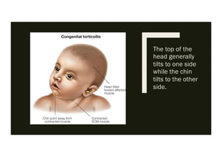 Torticollis Physiotherapy For Pediatrics pdf