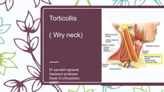 Torticollis
( Wry neck)
Dr saurabh agrawal
Assistant professor
Deptt of orthopedics
AIIMS
 