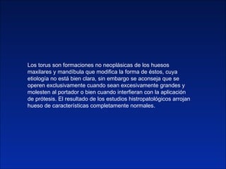 Los torus son formaciones no neoplásicas de los huesos maxilares y mandíbula que modifica la forma de éstos, cuya etiologí...