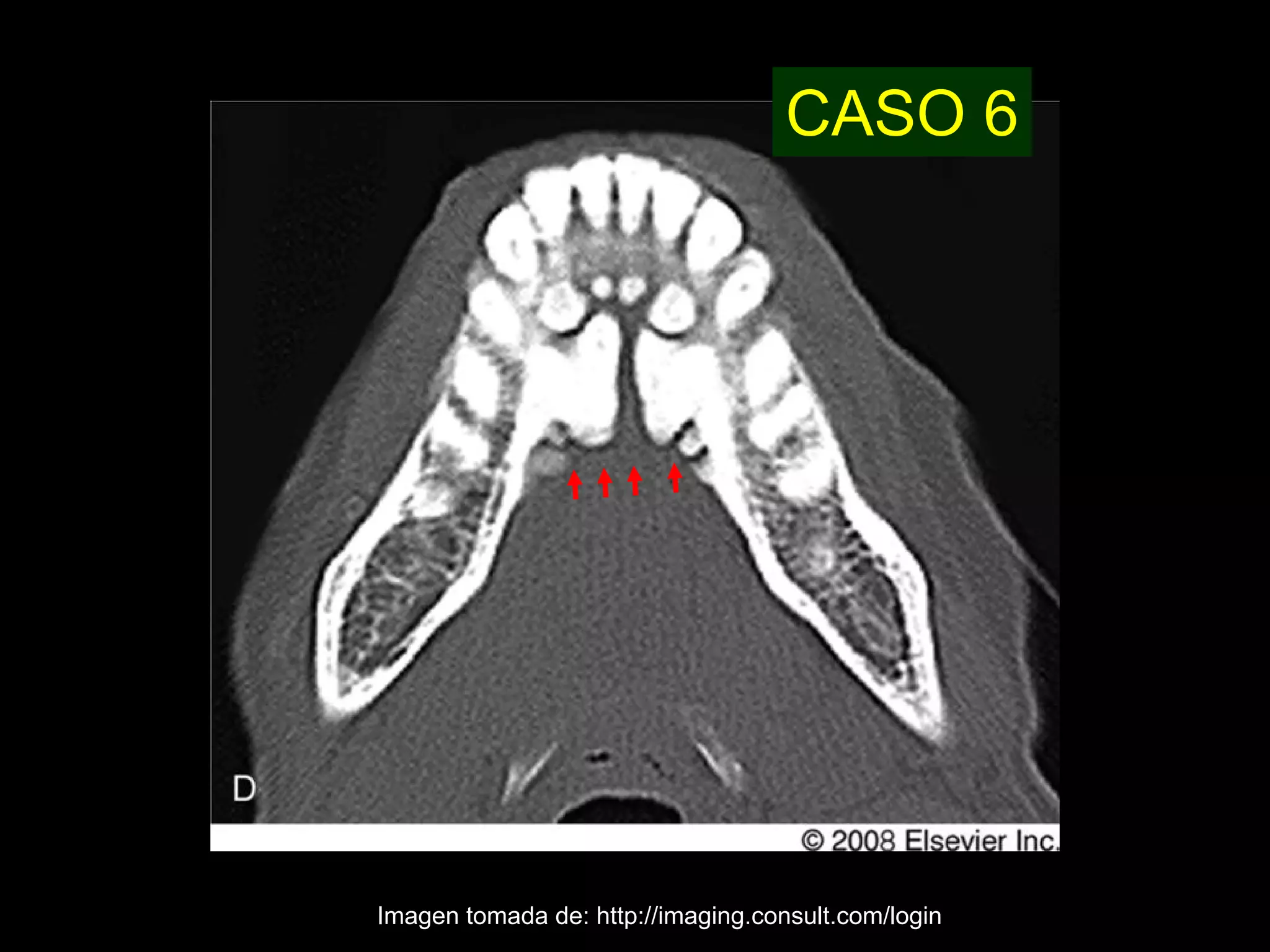 Torus Mandibular | PDF